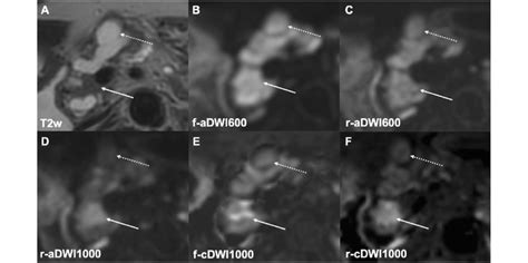 A mixed-type IPMN in a 75-year-old female patient. The solid tissue ...