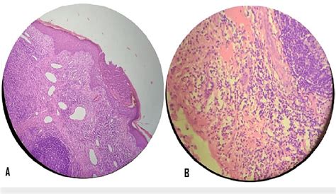 [PDF] A Rare Case of Angiolymphoid Hyperplasia With Eosinophilia With a New Effective Treatment ...