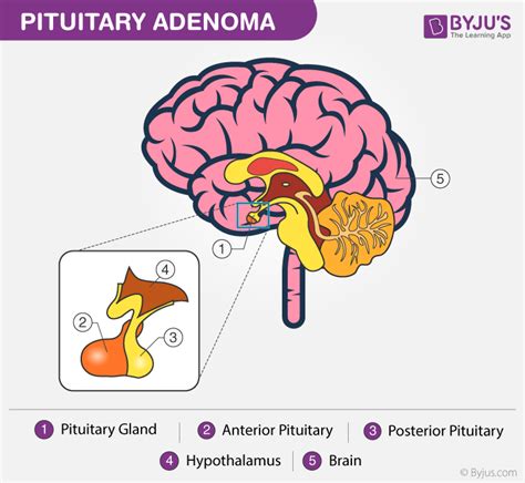 Pituitary Adenoma - Symptoms, Treatments and its Causes