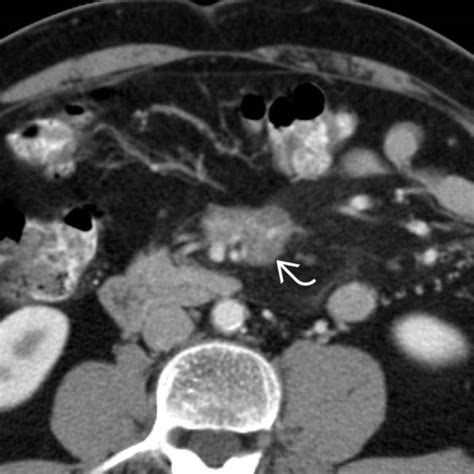 Sclerosing Mesenteritis | Clinical Gate