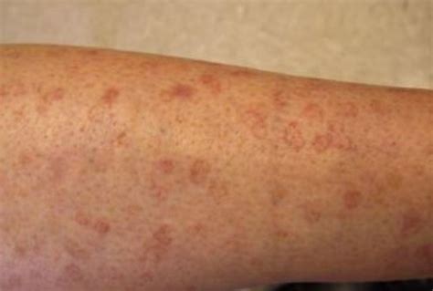 Brown spots on legs | Spots on legs, Age spot treatment, Brown spots