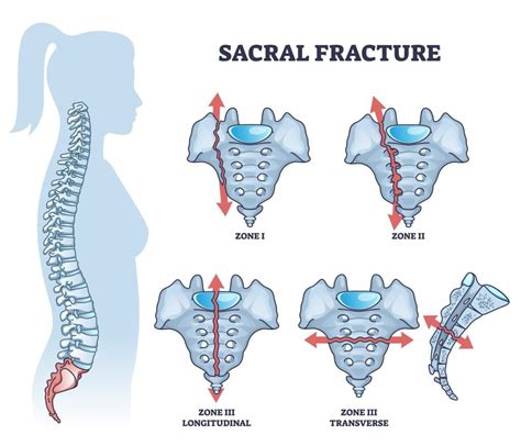 Sacral Insufficiency Fractures - Physioflow PT | Physical Therapy | Vancouver, WA