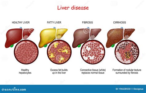 Liver Diseases. Stages of Liver Damage Stock Vector - Illustration of ...