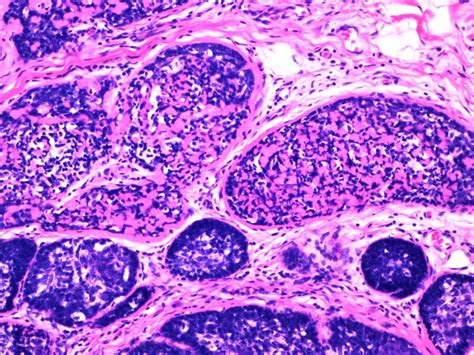 Pathology Outlines - Eccrine spiradenoma