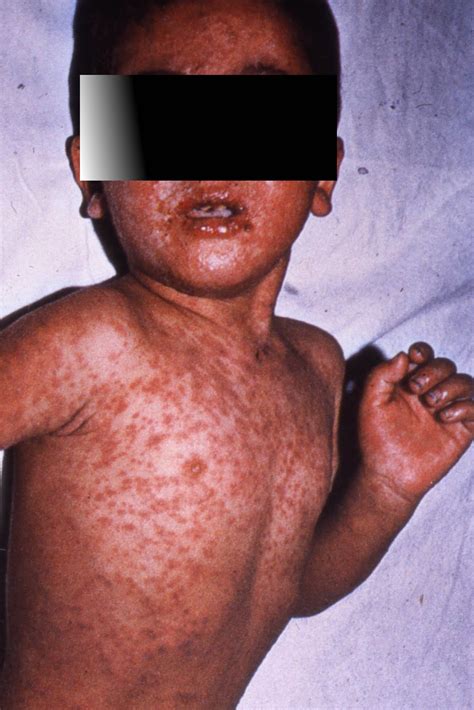 Infection Landscapes: Measles Part 1: The Virus, the Disease, and the Dynamics