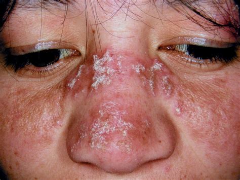 Discoid Lupus Erythematosus Primarily Affects Your Skin