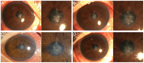 Localized lesions before and after surgery in the corneal cross-linking... | Download Scientific ...