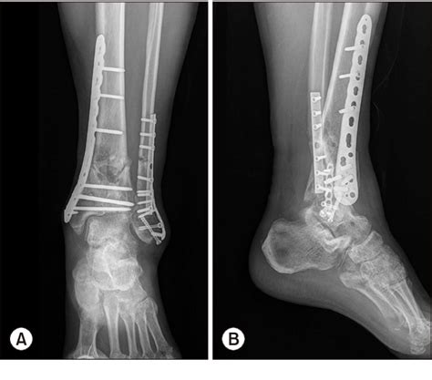 Post-traumatic osteoarthritis. (A) Anteroposterior X-ray. (B) Lateral... | Download Scientific ...