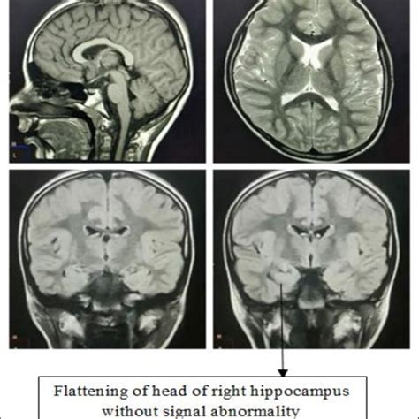 MRI brain, did not reveal any significant abnormality. | Download ...