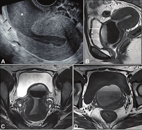 Transvaginal ultrasound image (A) shows a retroflexed uterus with ...