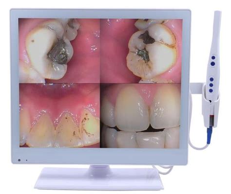 Dr. Lupsa Dentistry | Intraoral Camera in {CITY}