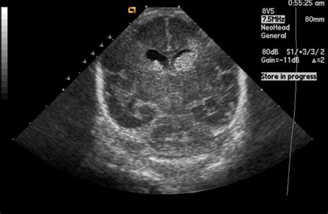 Germinal matrix hemorrhage - wikidoc