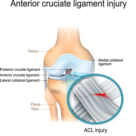 Knee-Ligament-Injury | Simply Align Rehab