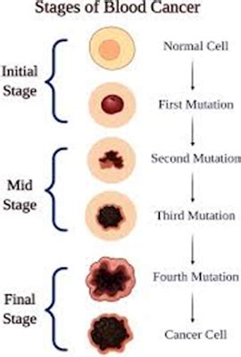 Blood Cancer - Types, Causes, Medications, Precautions, Symptoms