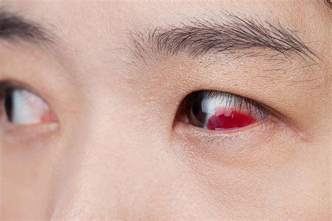 Minor Eye Trauma: Examples And Treatment