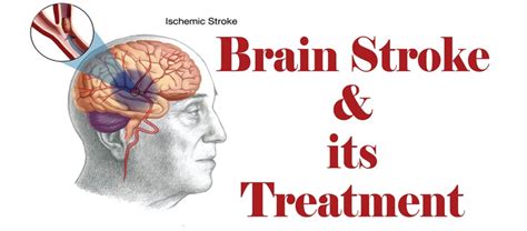 Aid Yourself with Stem cell treatment for Brain stroke injury