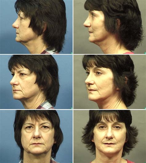 Facelift Before & After Photos by Dallas Plastic Surgeon Dr. Mark Deuber