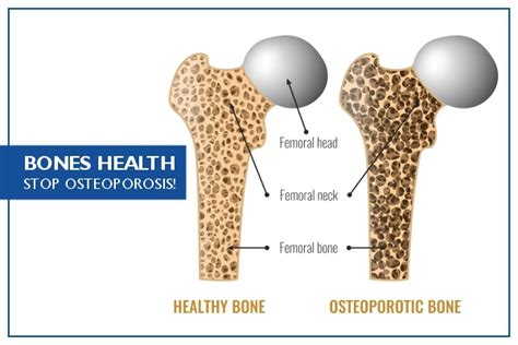 Osteopenia: Symptoms, Treatment, Causes, Dos And Donts, 59% OFF