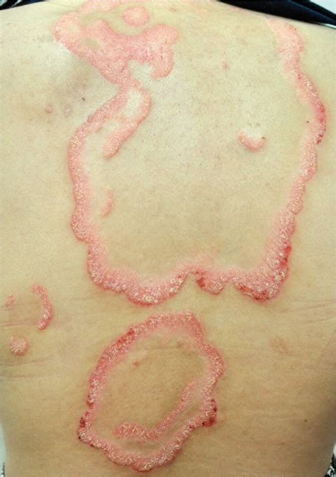 9 Types of Psoriasis: Pictures, Symptoms, Triggers, Diagnosis and ...