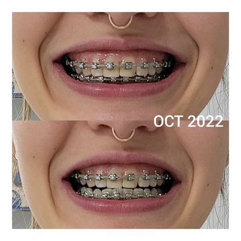 Braces Progress : r/braces