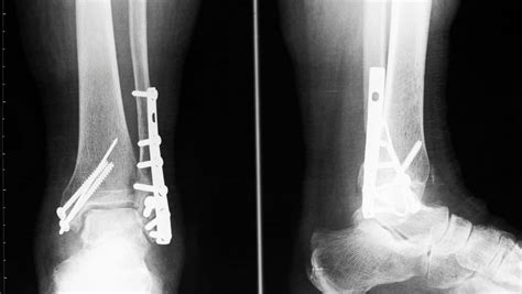 Lateral Malleolus Fracture | Lateral Malleolus Fracture Treatment