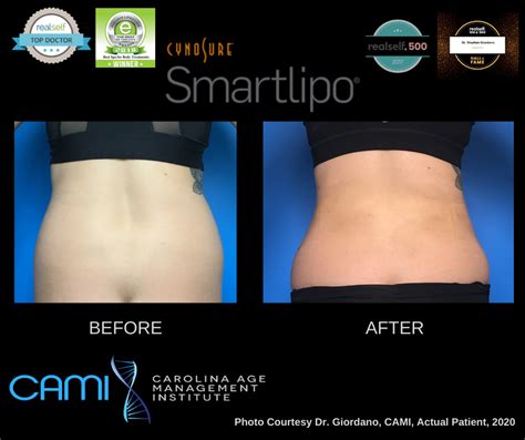 Laser Lipo Charlotte, NC | Smart Liposuction In Greensboro, NC