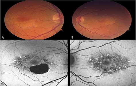 BULL'S EYE MACULOPATHY WITH MUTATIONS IN RDS/PRPH2 AND ROM-1 : Retinal Cases and Brief Reports