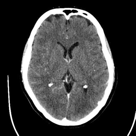 CT head (protocol) | Radiology Reference Article | Radiopaedia.org