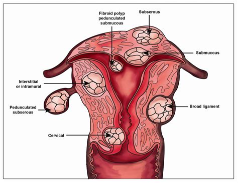 Fibroid in Pregnancy - Pitter Patter