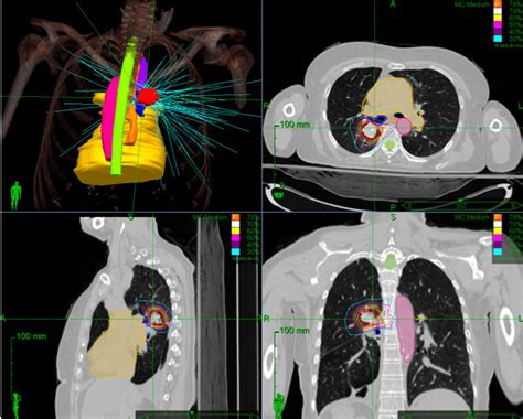 Stereotactic body radiation therapy - Dr. Sanjoy Roy