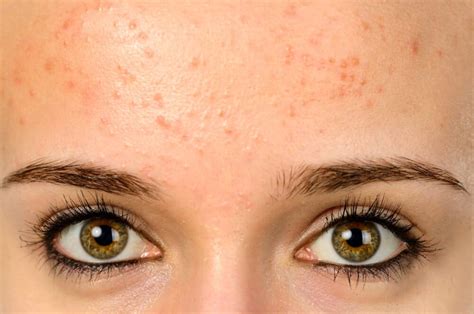 Fungal Acne: How to Know if You Have it ~ and How to Treat it