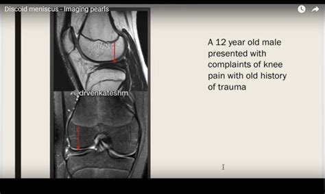 Discoid meniscus – Imaging pearls — OrthopaedicPrinciples.com