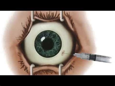 Injection Treatment for Wet Macular Degeneration | Macular degeneration, Treatment, Wet