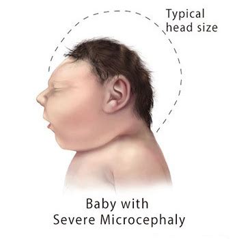 Microcephaly