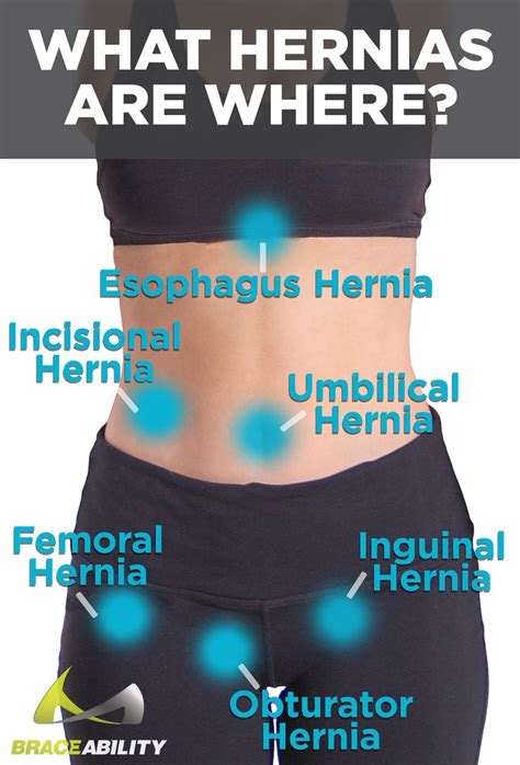 20 best Hernia Types & Treatment | Abdominal, Umbilical, and Inguinal Hernias - How to Avoid ...