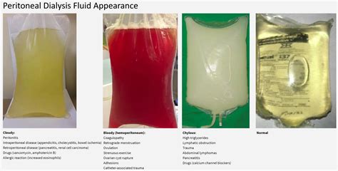 Paracentesis Fluid