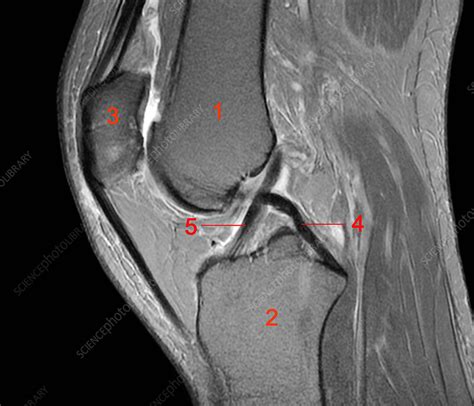 Normal Mri Knee