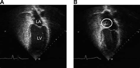 Echocardiograms from a subject with patent formen ovale (PFO ϩ ). A... | Download Scientific Diagram