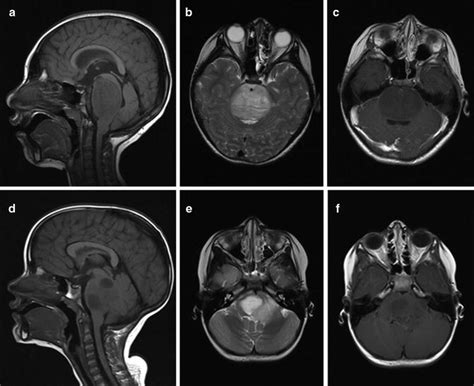 Diffuse Intrinsic Pontine Glioma | Obgyn Key