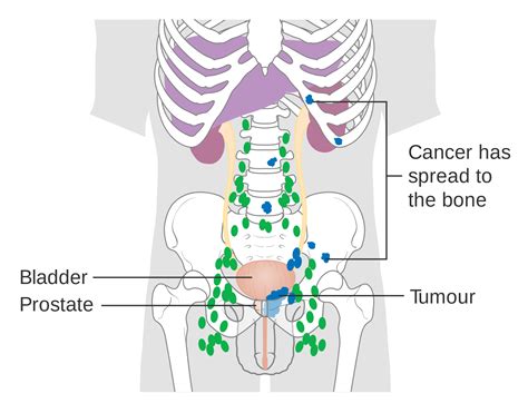 Prostate cancer level T1c Gleason 6