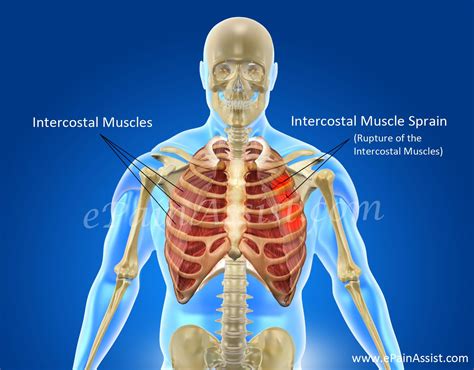 Intercostal Muscle Sprain|Causes|Symptoms|Diagnosis|Treatment-Conservative, Medications ...