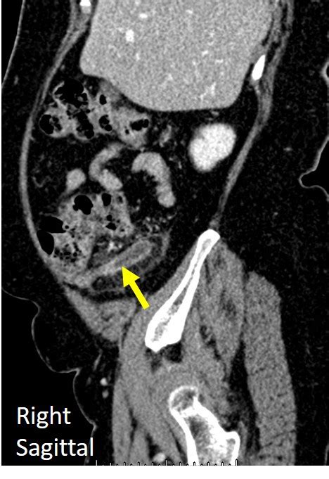 Acute appendicitis: transverse retrocaecal appendix – Radiology Cases