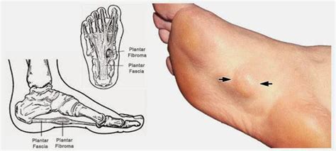 Information About Plantar Fibromatosis