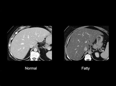 Normal Ct Scan Abdomen