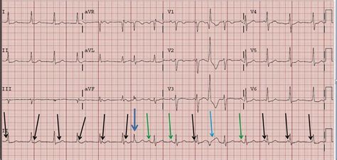 Dr. Smith's ECG Blog: AV Dissociation. Is there AV block?