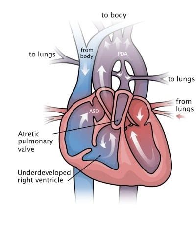 Pulmonary Atresia | Lurie Children's