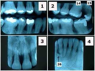 X-rays of gum disease show radiographic bone loss