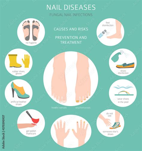 Nail diseases. Onychomycosis, nail fungal infection causes, treatment icon set. Medical ...