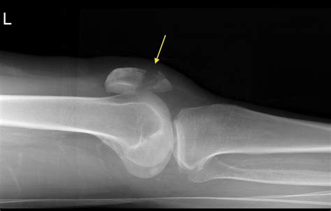 Patellar fracture - Radiology at St. Vincent's University Hospital