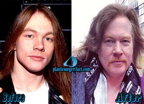 Axl Rose Plastic Surgery Before and After Photos